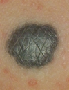 Erythematous palmar lesions Blueblack mole with regular borders Extremely pruritichyperkeratotic papules