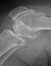 A new understanding of osteoarthritis