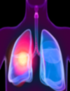 NonSmall Cell Lung Cancer iNewsletter Series