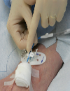 Troubleshooting complications of vascular access devices