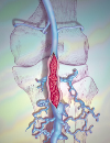 Using anticoagulants to treat chemotherapyrelated VTE