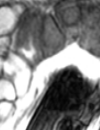 An Update Radiation or Surgery for Prostate Cancer
