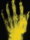 Managing Bone Disease in Kidney Transplant Recipients