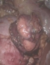 An Update on Robotic-Assisted Partial Nephrectomy