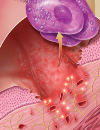 Interstitial cystitis A current guide to diagnosis and treatment A casualty of the immunization wars The reemergence of measles