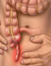 Acute appendicitis Antibiotics instead of surgery Diagnosis and management of mononucleosis