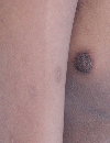 Asymptomatic skin lesions Isolated areas of darkening skin Dirtyappearing truncal eruption
