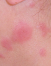 Diffuse erythematous papules Pink papules Scalp plaque