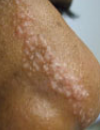 Linear pink papules Pink, pearly nasal papule Macular lip lesion