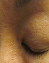 Yellow facial growths Vesicular eruption Depigmented area
