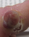 Yellow papules Swollen chest nodule Bleeding blister