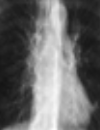 Dyspnea with comorbid heart failure and COPD