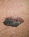 Newly developed brown papules Spreading macules Hardened plaque