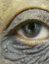 Discoloration of the eyelid