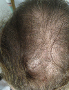 Thinning hair at the frontal scalp and crown Painful shin lesions described as bumps
