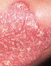 Growing skin plaques Thick, leathery, and red skin Papule with no pain or itching