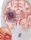 An old but increasingly deadly infection Interventions in acute largevessel ischemic stroke