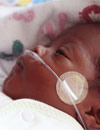 Case 1: A Male Infant With Breathing Problems Who Was Born at 33 Weeks' Gestational Age