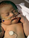 Case 2 An Infant Boy With Chronic Lung Disease of Prematurity