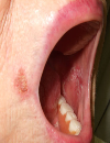 White plaques in the oral cavity Extremely pruritic rash on the back and chest Facial pustules after radiation treatment