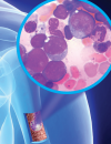 A 54-Year-Old Caucasian Male Complains of Fatigue