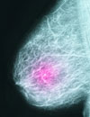 Case 3: A 46-Year-Old African American Female with Triple-Negative Breast Cancer