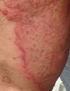 Erythematous, pruritic leg plaques Itchy leg bullae after a trip outdoors Firm, red plaques and xerotic skin