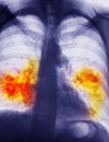 Crizotinib Benefits in NSCLC Explored, Including in Patients with ROS1 Gene Rearrangement and with Ablative Local Therapy