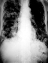 Future of Lung Cancer Screening Includes Risk Prediction Models, Biomarkers