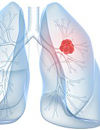 Targeting KRAS Mutant Tumors, Novel Therapies for NonSmallCell Lung Cancer