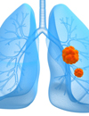 nabPaclitaxel Improves Overall Response Rate, Reduces Neuropathy in Patients with Advanced NonSmallCell Lung Cancer Regardless of Histology Elderly Also Benefit