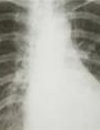Crizotinib Provides Clinically Meaningful Antitumor Activity in Patients with Previously Treated ALKPositive Advanced NonSmallCell Lung Cancer