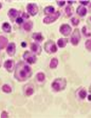 Pomalidomide Active in Patients with Multiple Myeloma Refractory to Lenalidomide, Bortezomibor Bothand in Transplant Failures