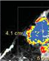 Weekly Paclitaxel After Adjuvant FAC Offers Modest, but Clinically Relevant Improvement in DiseaseFree Survival in Patients with HighRisk, NodeNegative Breast Cancer