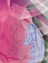 Accelerated cardiovascular disease in patients with lupus A review Oral health during pregnancy What the practicing PA needs to know