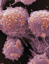 Current Controversies Surrounding PSA Screening