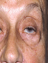 A collaborative approach to myasthenia gravis