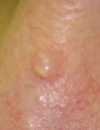 Hyperpigmented cheek patches Chest papule turns red when rubbed Painless, nongrowing nasal lesion