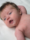 Case 1 A Newborn Baby Whose Older Sibling Has Moderately Severe Atopic Dermatitis