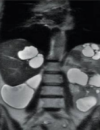 The Association Between Kidney Failure and Renal Cell Carcinoma