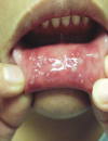 Ulcerations in the oral cavity Small brown spots on the lower shins Erosions on the hands and elevated iron levels