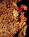 New paradigms in managing chronic kidney disease
