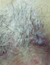 Intertriginous erosions Red scalp plaque with painful ulceration Discolored patches from wrist to elbow