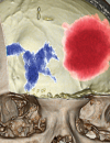 Evaluation and treatment of acute cerebral ischemia
