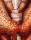 Thyroid Functional Disease in Dialysis Patients