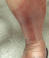 Plaques on the lower extremities Discoloration worsens following sun exposure Arm ulcer on a Latin American immigrant