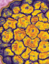 Primarycare prevention of cervical cancer