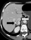 Adrenal Masses Often Incidental, Not Always Insignificant