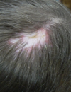 White plaques on the tongue Tender, atrophic plaque on the arm and chest Firm, indurated scalp lesion with hair loss