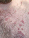 Skincolored papules Purple trunk plaques on a homosexual man Blue discoloration on both arms and legs